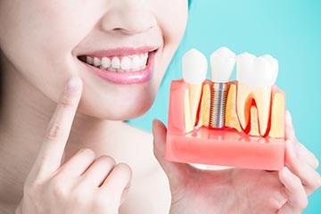 Dental Implants