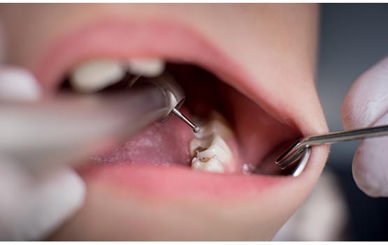 Open mouth during drilling treatment at the dentist in dental clinic. Close-up. Dentistry