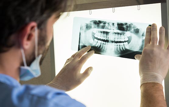 X-Ray For Wisdom Tooth Extraction