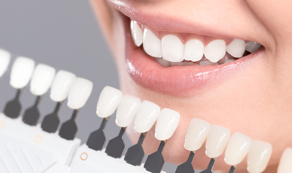veneer color matching