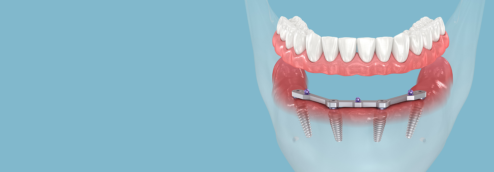implant supported dentures