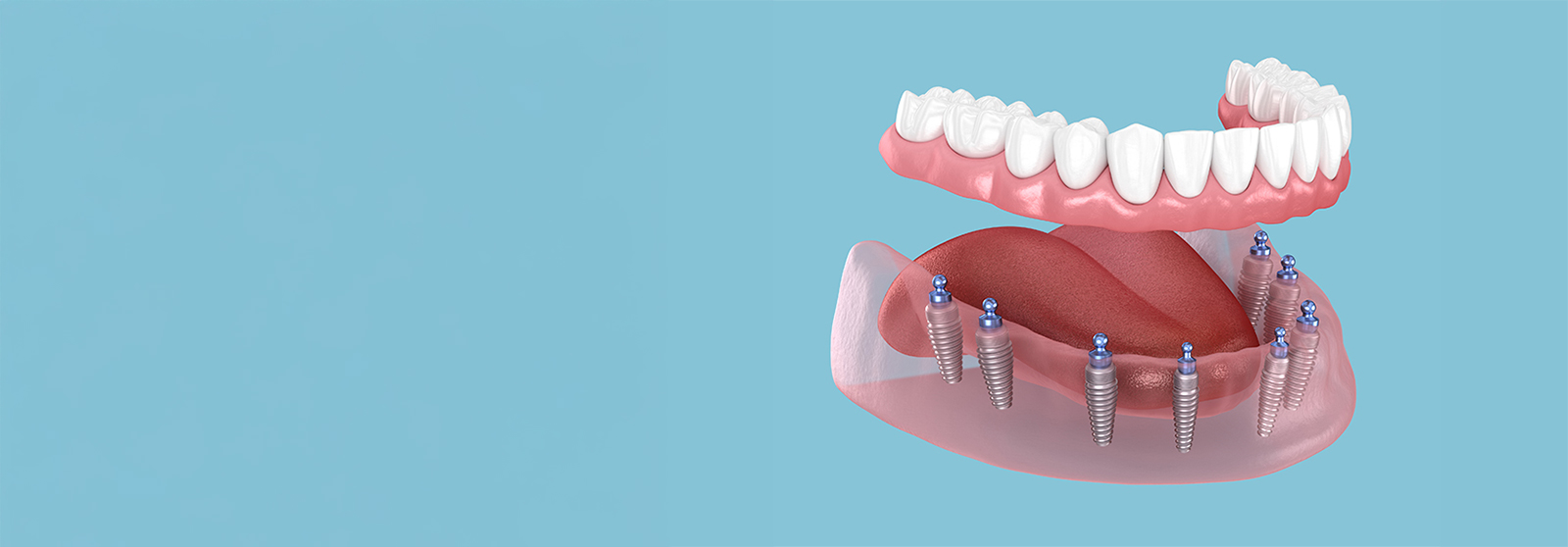 over dentures