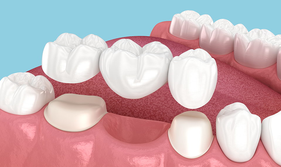 dental bridge